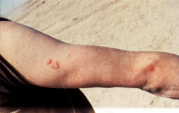 Figure 5. Private Fisher blister injury - Dr. Dunn photo 1