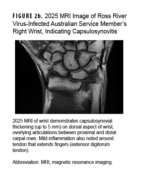 FIGURE 2b. 2025 MRI Image of Ross River Virus-Infected Australian Service Member’s Right Wrist, Indicating Capsulosynovitis This MRI scan is paired with another MRI scan to show the effects of a Ross River virus infection on a service member’s right wrist at two points in time. The second image, taken in 2025, shows that while the condition has improved, there is still evidence of mild, persistent inflammation and thickening in the joint capsule. The purpose is to visually document the initial severity and lingering effects of the virus-induced arthritis.