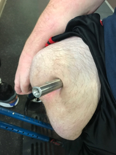 Osseointegration (OI) is the use of a surgical implant to achieve direct skeletal attachment of a prosthetic limb to the residual limb of a person with an amputation. 