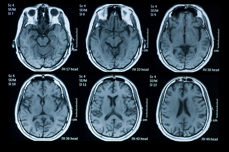 Image of MRI film (iStock.com/temet). Click to open a larger version of the image.