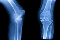 Osteoarthritis (OA) knee . film x-ray AP ( anterior - posterior ) and lateral view of knee show narrow joint space, osteophyte ( spur ), subchondral sclerosis, knee joint inflammation. Photo by: iStockPhoto