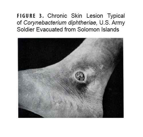 FIGURE 3. Chronic Skin Lesion Typical of Corynebacterium diphtheriae, U.S. Army Soldier Evacuated from Solomon Islands. This figure presents a historical photograph of a skin lesion from C. diphtheriae.     