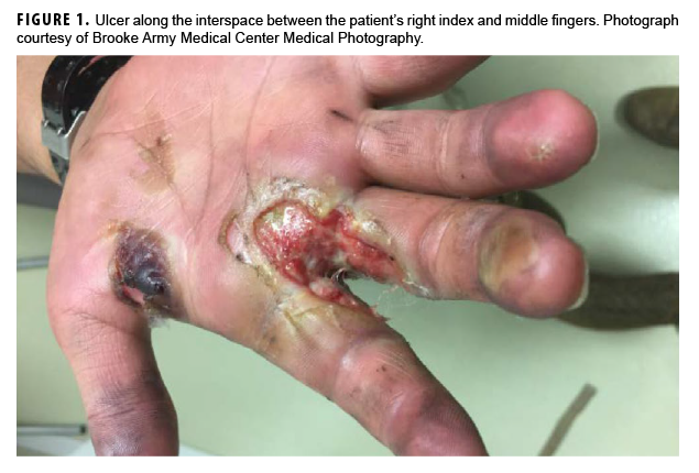 Ulcer along the interspace between the patient’s right index and middle fingers. Photograph courtesy of Brooke Army Medical Center Medical Photography