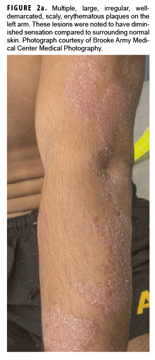 Multiple, large, irregular, welldemarcated, scaly, erythematous plaques on the left arm. These lesions were noted to have diminished sensation compared to surrounding normal skin. Photograph courtesy of Brooke Army Medical Center Medical Photography.