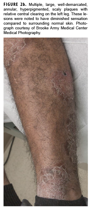Multiple, large, well-demarcated, annular, hyperpigmented, scaly plaques with relative central clearing on the left leg. These lesions were noted to have diminished sensation compared to surrounding normal skin. Photograph courtesy of Brooke Army Medical Center Medical Photography.