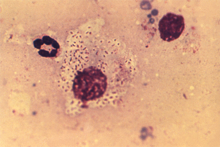 Image of This photomicrograph of a tissue sample extracted from a lesion in the inguinal region of the female granuloma inguinale, or Donovanosis patient, depicted in PHIL 6431, revealed a white blood cell (WBC) that contained the pathognomonic finding of Donovan bodies, which were encapsulated, Gram-negative rods, representing the responsible bacterium Klebsiella granulomatis, formerly known as Calymmatobacterium granulomatis. Photo credit: CDC/ Susan Lindsley.