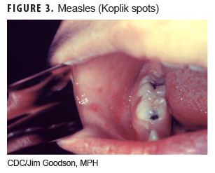 Measles (Koplik spots)