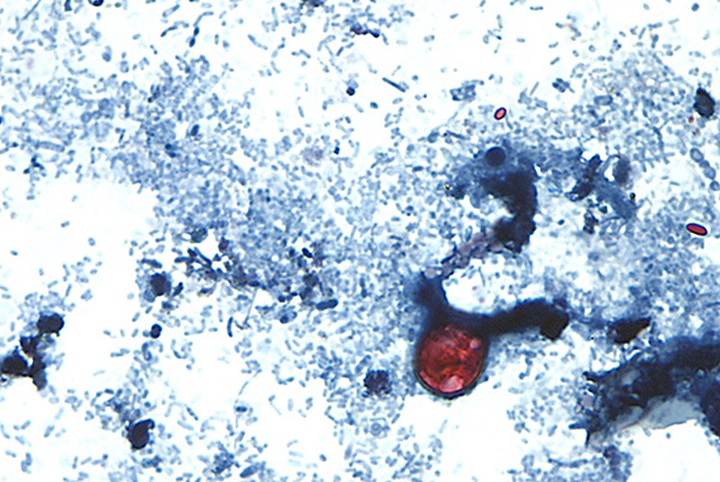 Image of Cyclosporiasis.