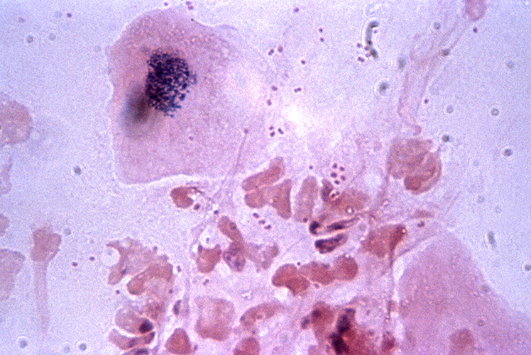 Image of Neisseria gonorrhoeae Photo Courtesy of CDC: M Rein.