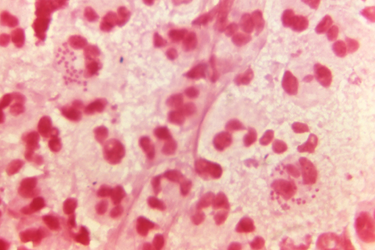 Under a magnification of 1150X, this photomicrograph of a Gram-stained urethral discharge specimen, demonstrated the presence of Gram-negative, intracellular diplococci, which is a finding indicative of the possible presence of Neisseria gonorrhoeae bacteria.  Credit: CDC/ Dr. Caldwell