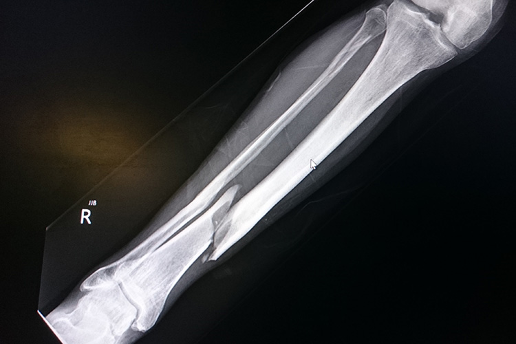 Image of X-ray image of a fractured tibia. Click to open a larger version of the image.