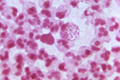Photomicrograph of a Gram-stained specimen demonstrating the presence of Gram-negative, intracellular diplococci, which is a finding indicative of the possible presence of Neisseria gonorrhoeae bacteria. Credit: CDC/Bill Schwartz