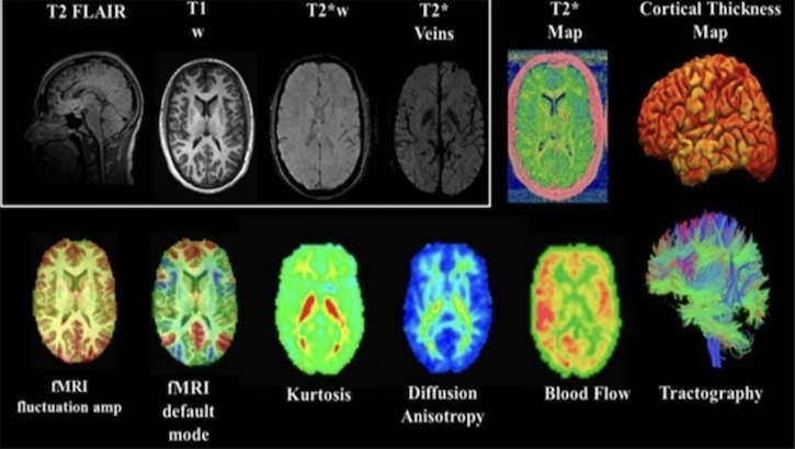 An MRI shows integrating multimodal imaging biomarkers of changes in brain structure and function. Mild traumatic brain injury, or concussion, is a major issue of concern in the military, as well as within the sports community. (Image courtesy of NIH.gov)