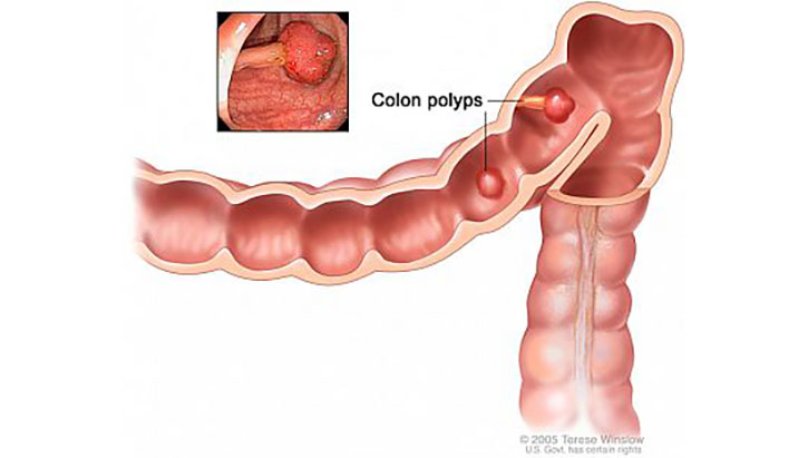 Image of Graphic image of a colon with polyps. Click to open a larger version of the image.