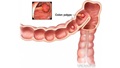 Graphic image of a colon with polyps.