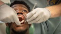 Marine Corps Lance Cpl. Jaden Murry had nearly all of his lower jaw removed because of a tumor. The procedure was the DOD’s first ever immediate jaw reconstruction surgery using 3D-printed teeth.