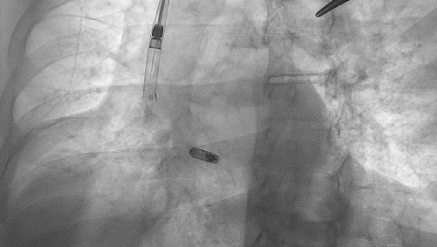 A radiographic image shows the "delivery sheath"--a tube cardiologists insert into a vein to provide access to the heart--and the pacemaker device (center) that will be secured in place to treat an irregular heartbeat.